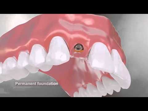 Dental Implants Procedure animation