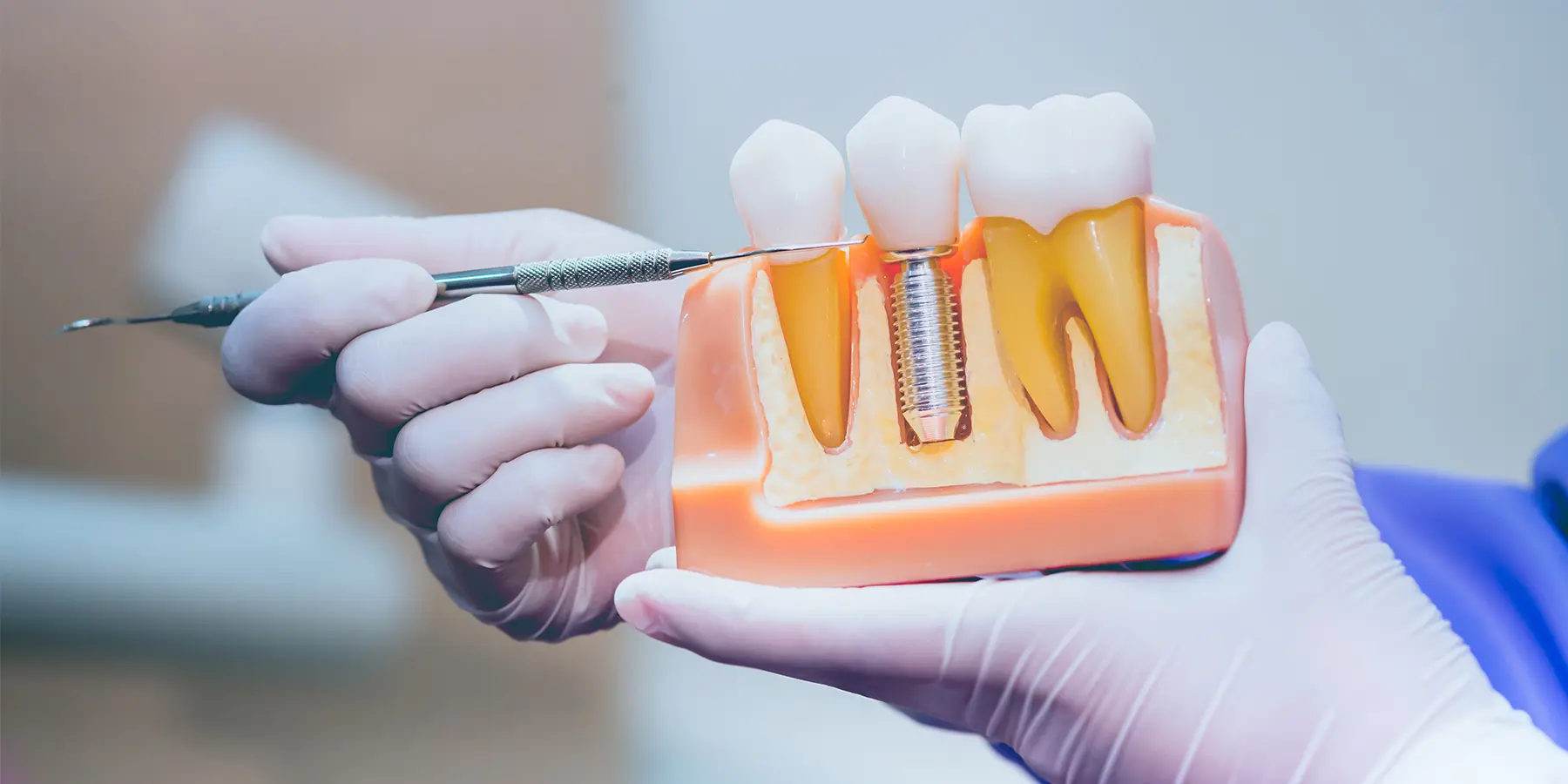 Why San Francisco Patients Trust Dr. Matthew Young for Dental Implants
