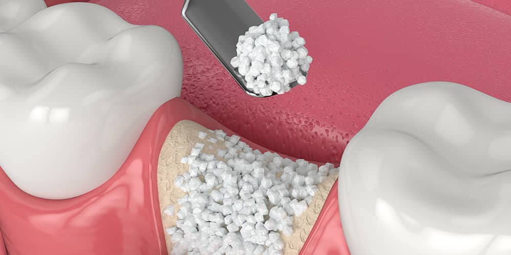 Bone Graft San Francisco