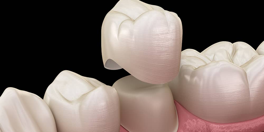 Dental Crowns San Francisco